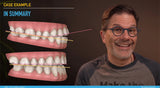 Treating anterior open bites with clear aligners (6 CE) The C.L.E.A.R. Institute