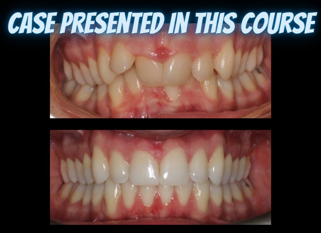 Class II treatments with clear aligners (4.5 CE)