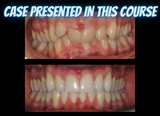 Class II treatments with clear aligners (4.5 CE)