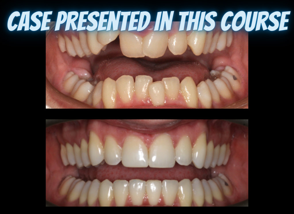 Class II treatments with clear aligners (4.5 CE)