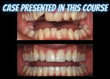 Class II treatments with clear aligners (4.5 CE)