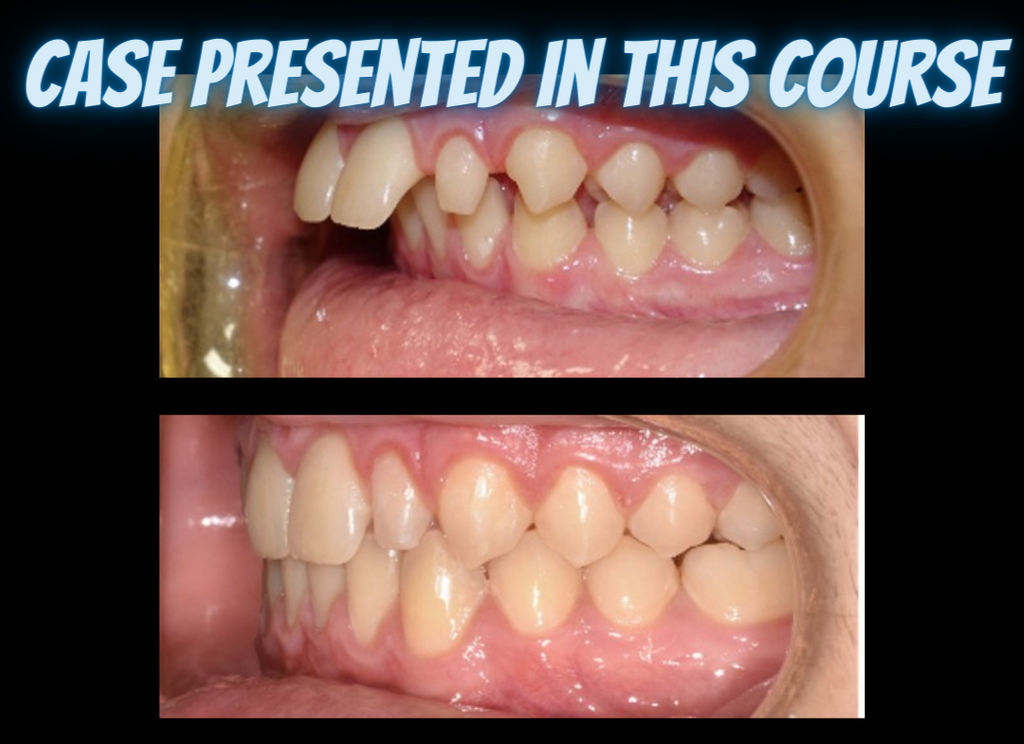 Class II treatments with clear aligners (4.5 CE)