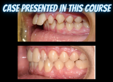 Class II treatments with clear aligners (4.5 CE)
