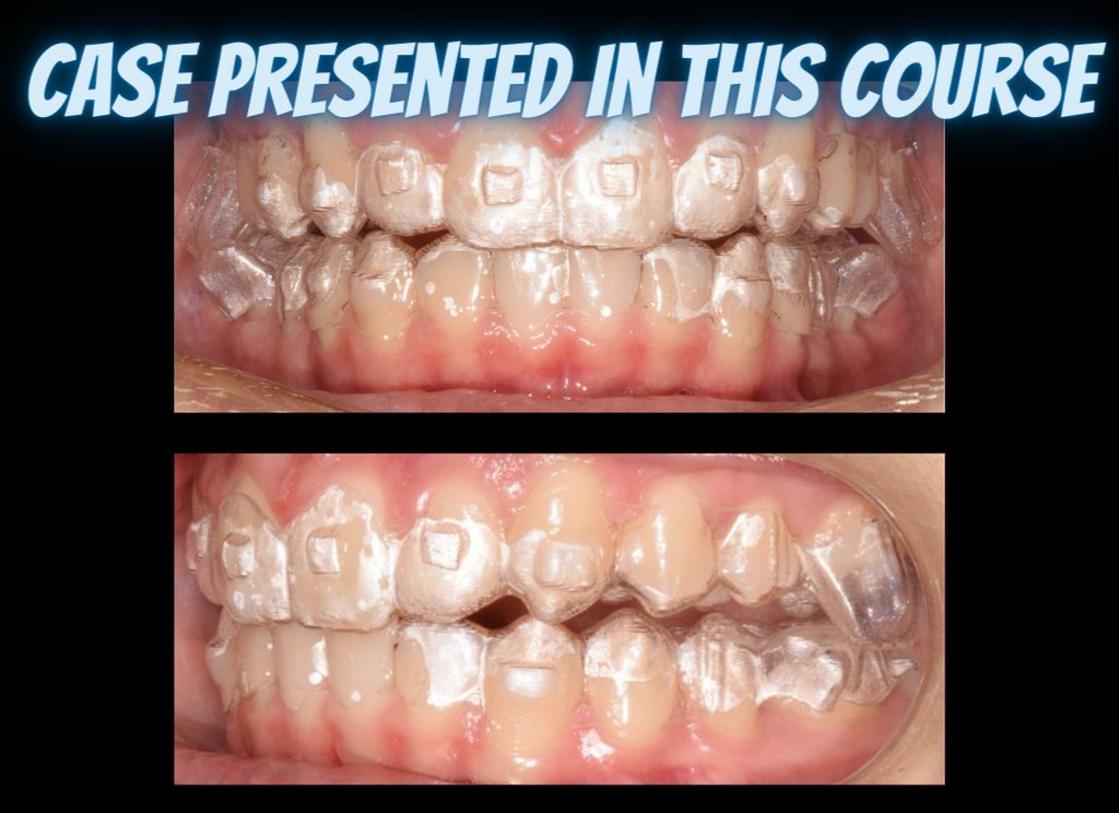 Class II treatments with clear aligners (4.5 CE)