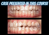 Class II treatments with clear aligners (4.5 CE)