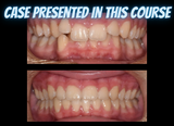 Class II treatments with clear aligners (4.5 CE)