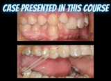 Class II treatments with clear aligners (4.5 CE)