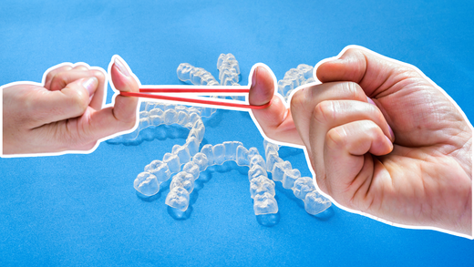Using clear aligners and elastics: a great combination!