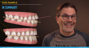 Treating anterior open bites with clear aligners (6 CE)