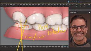 Treating anterior open bites with clear aligners (6 CE)