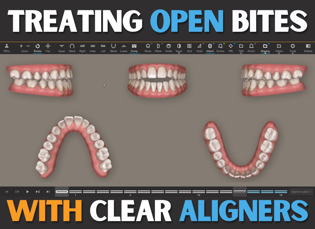 Treating anterior open bites with clear aligners (6 CE)