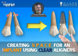 Creating Space for an Implant with Clear Aligners (ON-DEMAND WEBINAR)